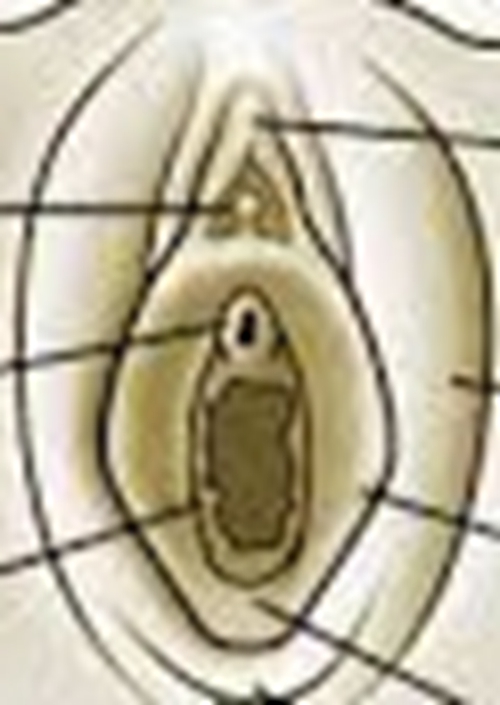 外陰潰瘍外部症狀