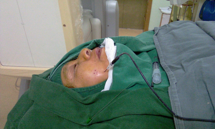 穴位注射治療三叉神經痛的臨床