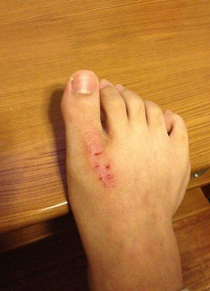 皮膚澱粉樣變 (58) 