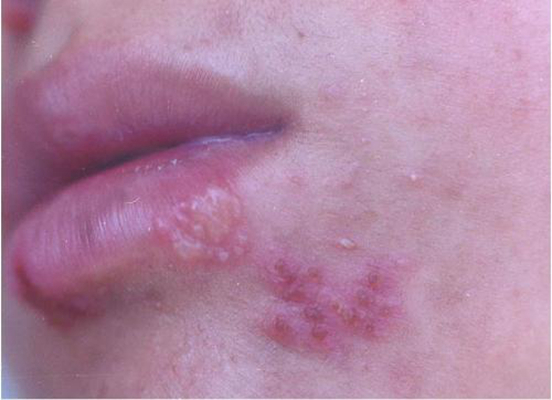 嘴上長皰疹 (50) 