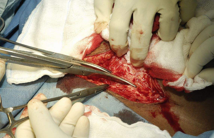 剖腹產手術 (44) 