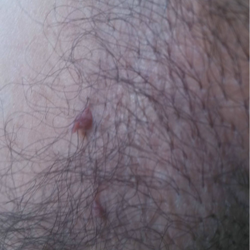 腋下皮膚息肉的