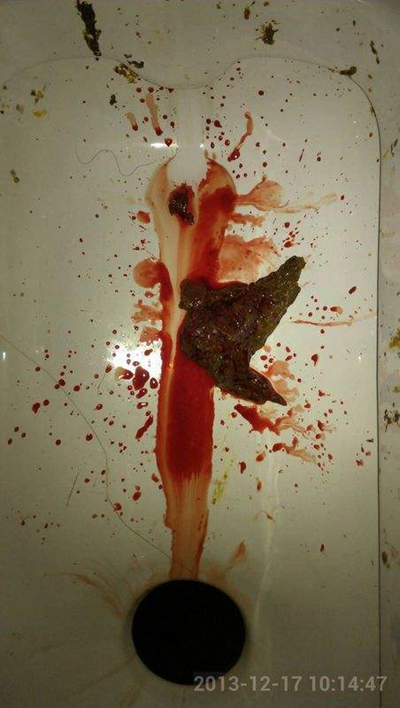 腸癌的症狀 (46) 