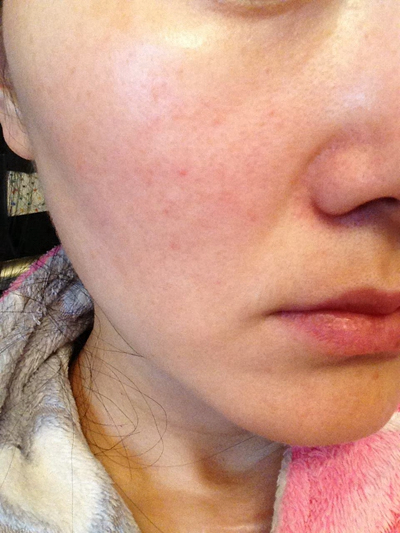 神經性皮炎的治療 (63) 