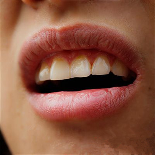 白塞病嘴唇