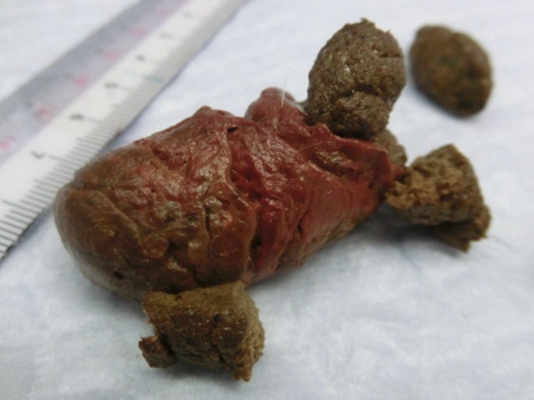 直腸癌晚期症狀 (40) 