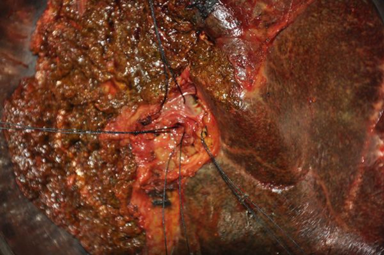 肝內膽管癌晚期症狀