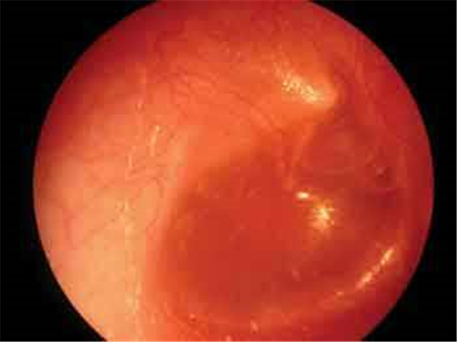 小兒急性中耳炎