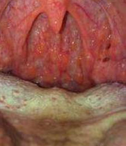 孕期的急性咽炎