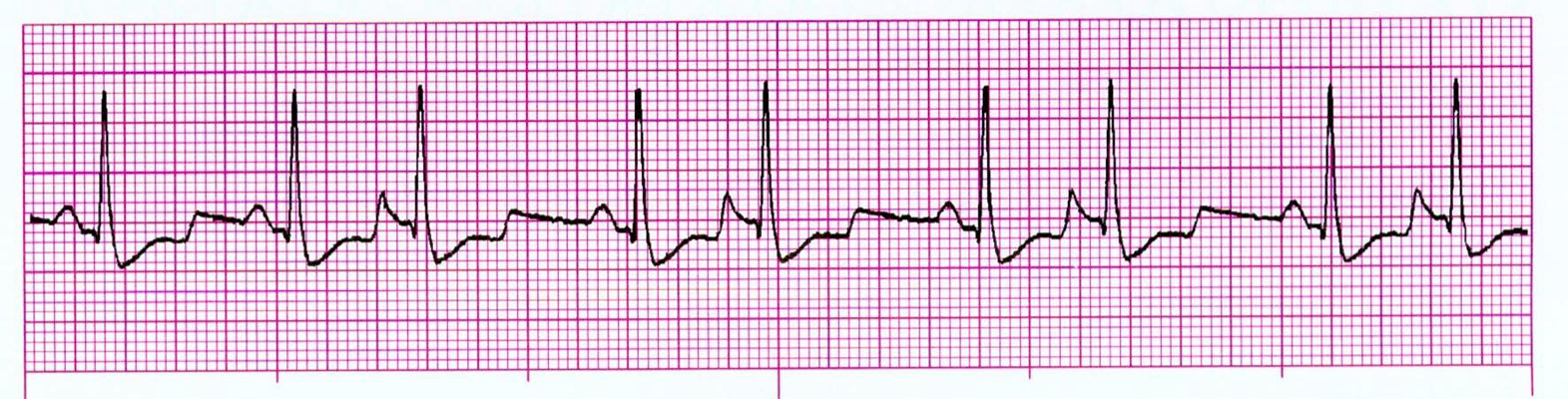 頻發房性早搏 (8) 