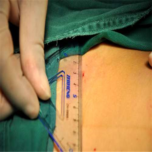 白線疝手術前測量