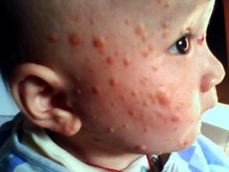 嬰兒皮膚黃色瘤病