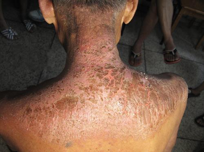 肩頸接觸性皮炎症狀