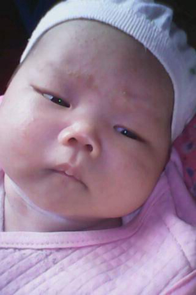 新生兒胎毒的症狀