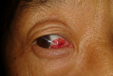 眼角膜發炎