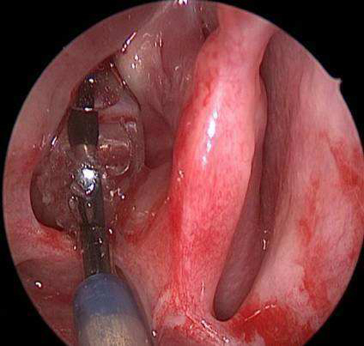 嚴重萎縮性慢性鼻炎