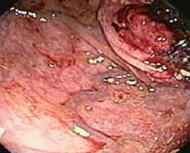 右半結腸癌的腺癌二級常見 臨床特點