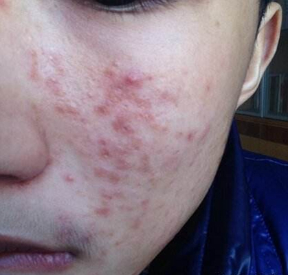 血熱的症狀痘痘