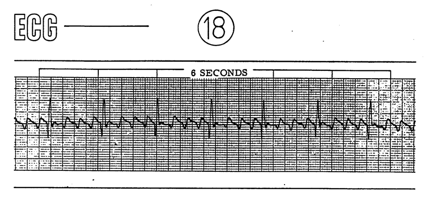 高鉀血癥心電圖 (6) 