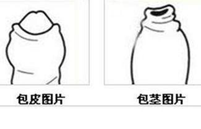 嵌頓包莖鬆解術圖解 