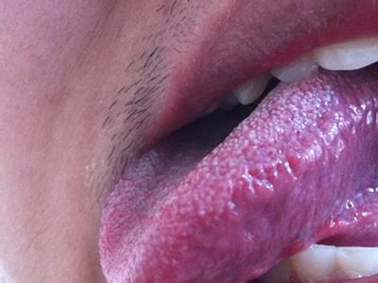 口腔念珠菌感染 (47) 