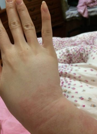 孕婦膽汁淤積症狀