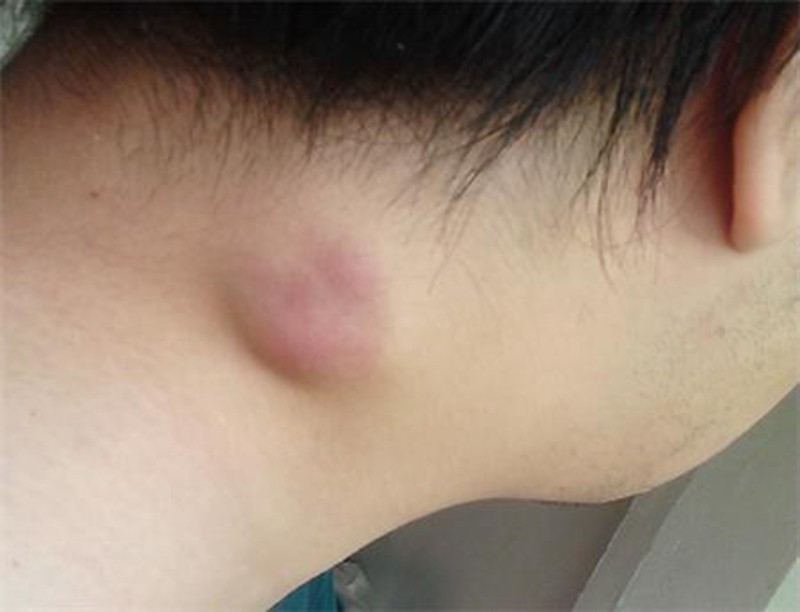 中年男淋巴結髮炎的