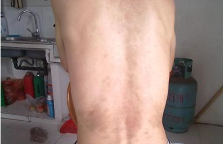 身上皮膚黑變病