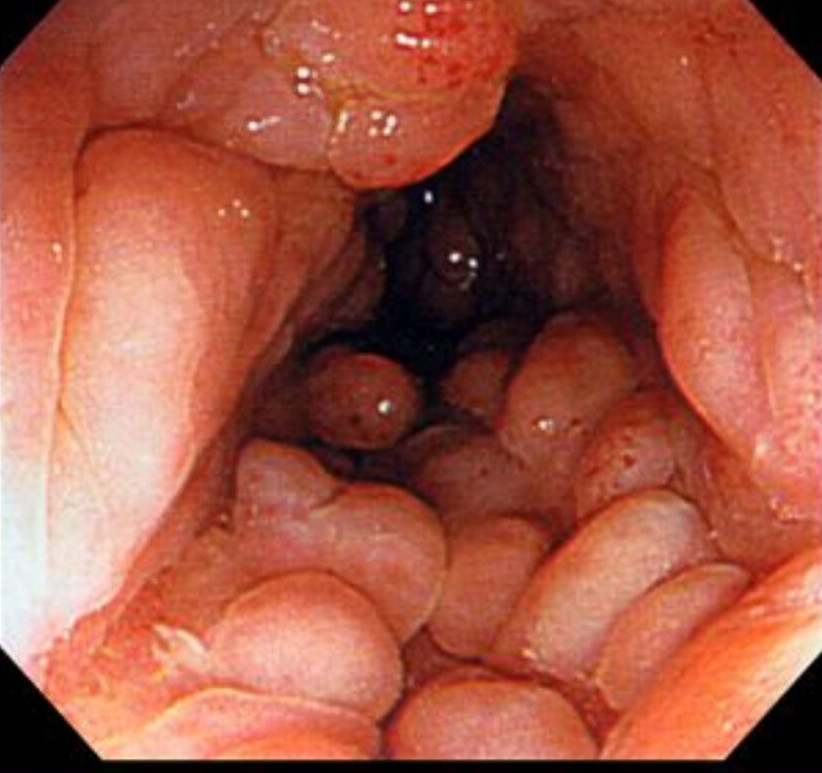 克羅恩病鏡下的