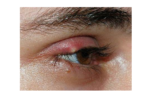 眼睛麥粒腫初期