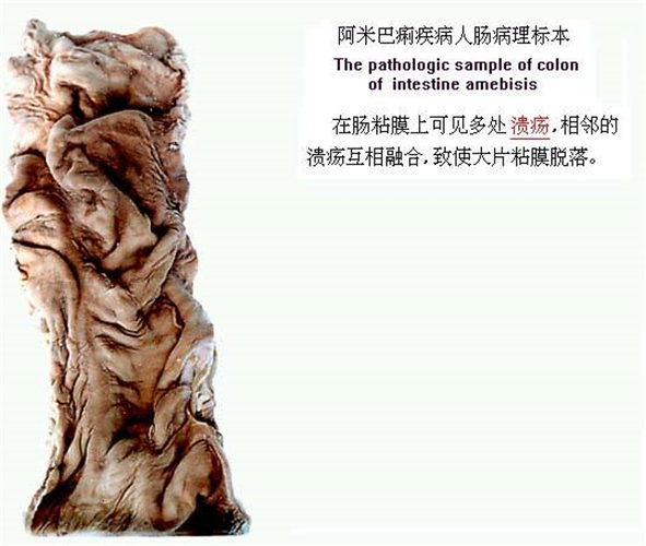 阿米巴痢疾標本
