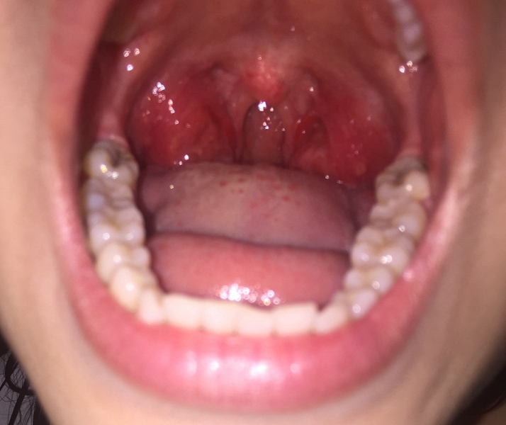 真實症狀口腔流感