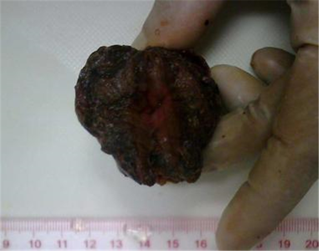 性腺發育不全的男性假兩性畸形