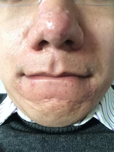 鼻子長蟎蟲症狀