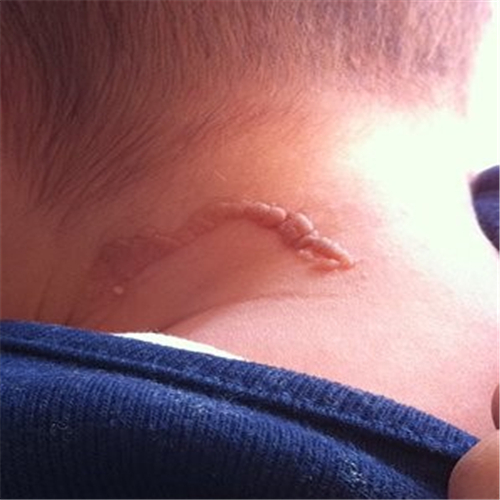 頸部皮脂腺痣