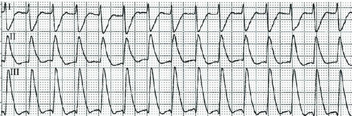 預激綜合徵心電圖 (91) 