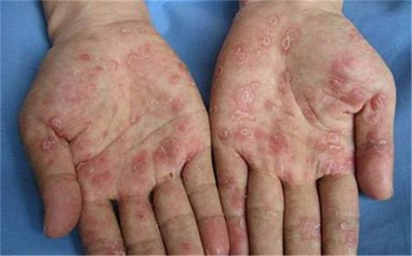 什麼傳染性軟疣 