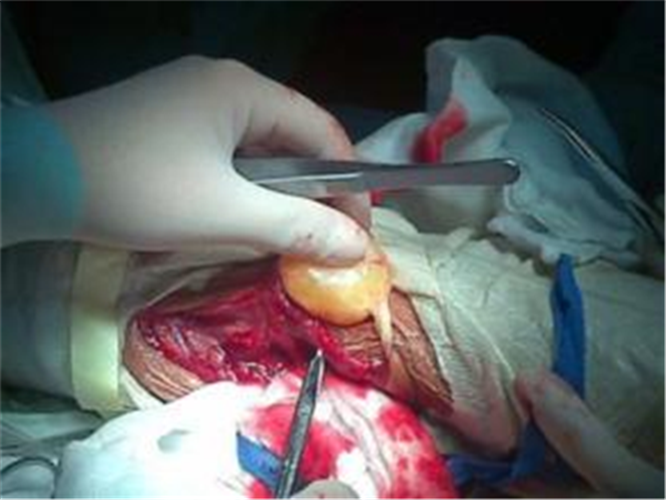 治療惡性骨腫瘤