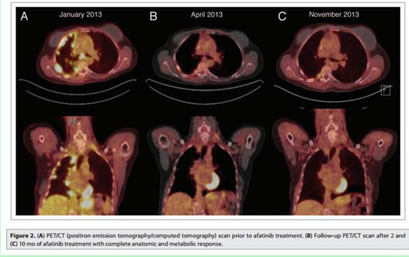 有效治療肺腺癌患者