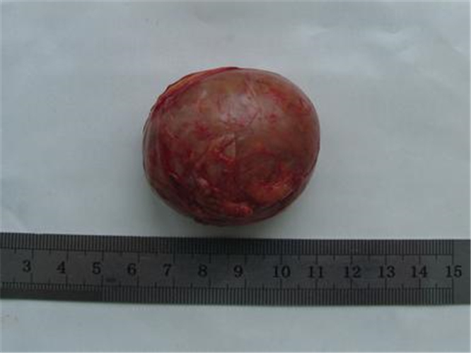 圓形的腎上腺腫瘤