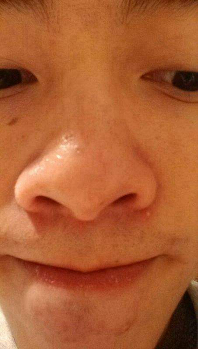 急性皮炎的症狀