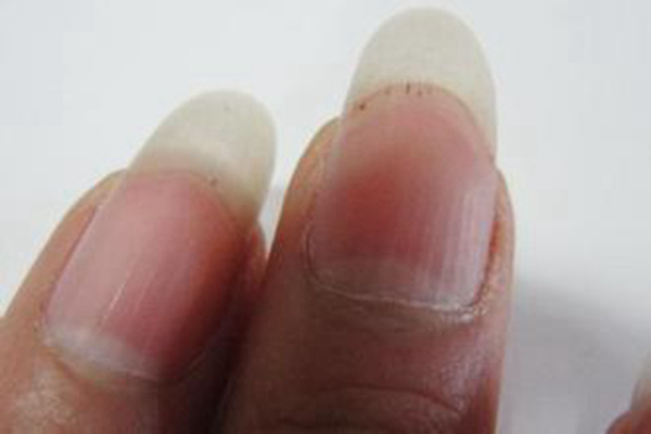 手指甲上有豎紋圖解 (40) 