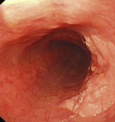 直腸癌晚期症狀 (4) 