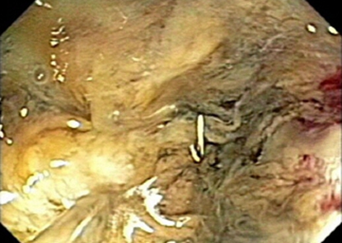 右半結腸癌的粘液腺癌常見臨床特點 