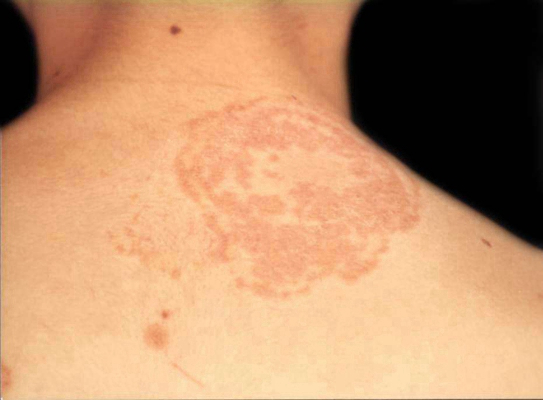 淋病的症狀 (53) 