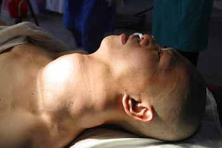 男性出現巨大喉腫瘤的