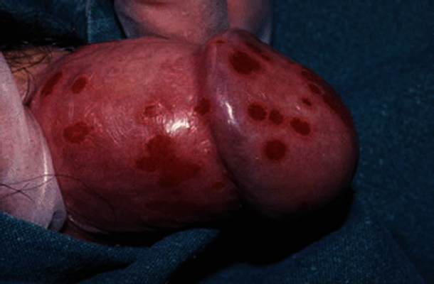 黴菌性龜頭炎 (27) 