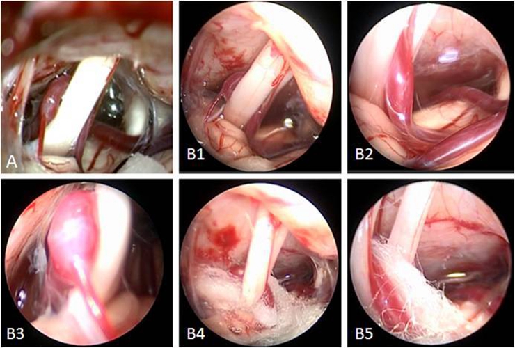 周圍性三叉神經痛