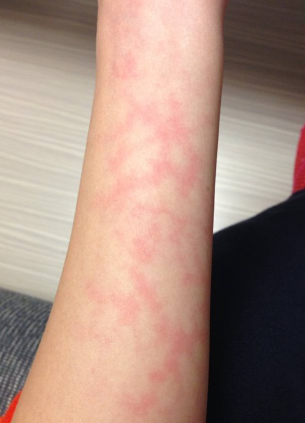 孕婦膽汁淤積症狀