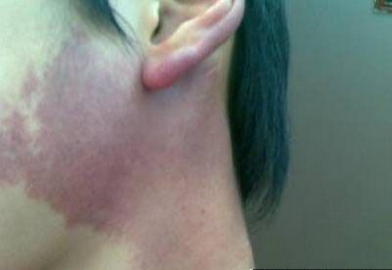 鮮紅斑痣的症狀